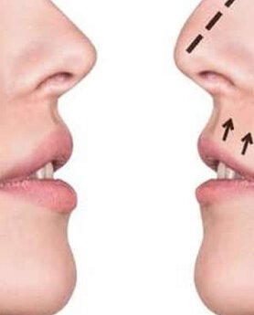 OPERACIJA NOSA - SVE ŠTO STE ŽELELI DA ZNATE