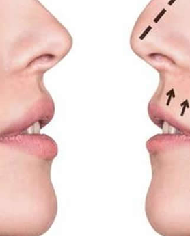 OPERACIJA NOSA - SVE ŠTO STE ŽELELI DA ZNATE