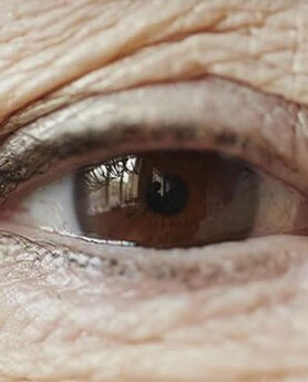 BLEFAROPLASTIKA – VRATITE STARI SJAJ VAŠIM OČIMA!