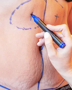 ABDOMINOPLASTIKA ILI LIPOSUKCIJA – KOJA PROCEDURA JE ZA VAS?