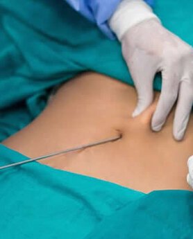 AKO RAZMIŠLJATE O LIPOSUKCIJI OVO MORATE DA ZNATE!