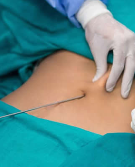 AKO RAZMIŠLJATE O LIPOSUKCIJI OVO MORATE DA ZNATE!