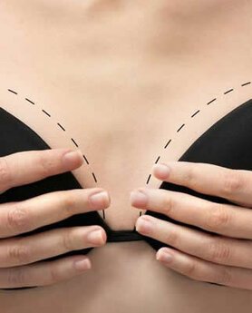 POVEĆANJE I PODIZANJE GRUDI – SVE ŠTO STE ŽELELI DA ZNATE