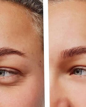 DROOPY EYELIDS – A QUICK AND EASY SOLUTION 