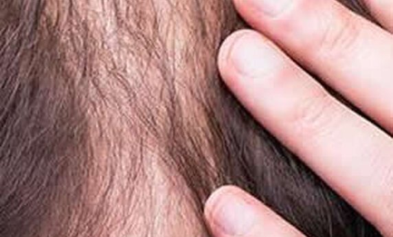 HAIR TRANSPLANT IS NOT A FRIGHTENING EXPERIENCE. HERE'S WHY!