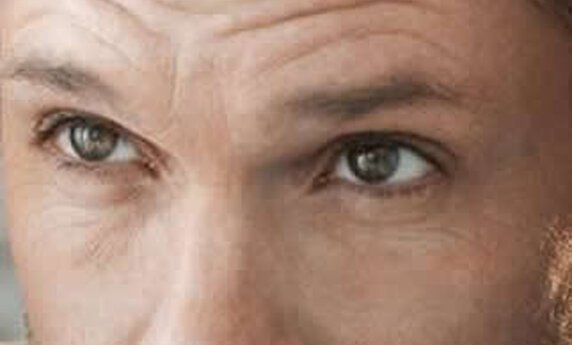 RECITE ZBOGOM ĆELAVOSTI – SIGURNA I EFIKASNA METODA PRESAĐIVANJA KOSE