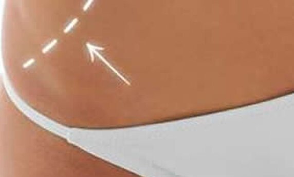 BRZO I LAKO DO ZATEGNUTOG I OBLIKOVANOG TELA - TOTAL BODY LIFTING