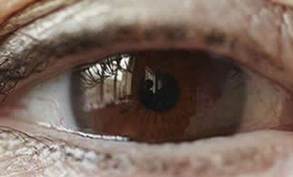 BLEFAROPLASTIKA – VRATITE STARI SJAJ VAŠIM OČIMA!