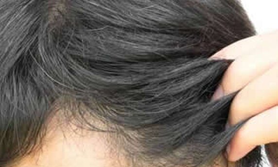 ARE YOU A GOOD CANDIDATE FOR HAIR TRANSPLANTATION?