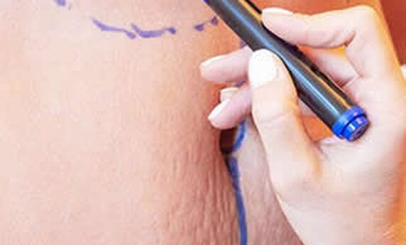 ABDOMINOPLASTIKA ILI LIPOSUKCIJA – KOJA PROCEDURA JE ZA VAS?