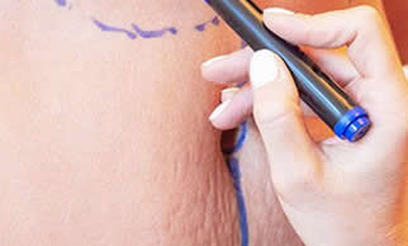 ABDOMINOPLASTIKA ILI LIPOSUKCIJA – KOJA PROCEDURA JE ZA VAS?