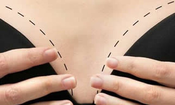 Breast Augmentation and Lift – Everything You Wanted to Know