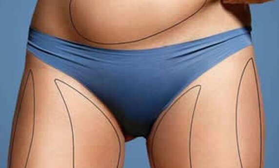 ESTETSKA HIRURGIJA – SKIDANJE SALA SA STOMAKA LIPOSUKCIJOM