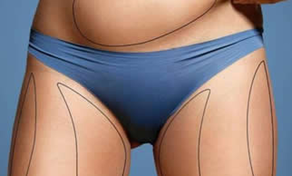 ESTETSKA HIRURGIJA – SKIDANJE SALA SA STOMAKA LIPOSUKCIJOM