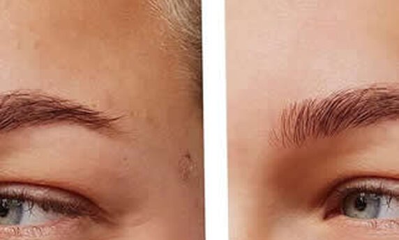 SPUŠTENI KAPCI – BRZO I LAKO REŠENJE